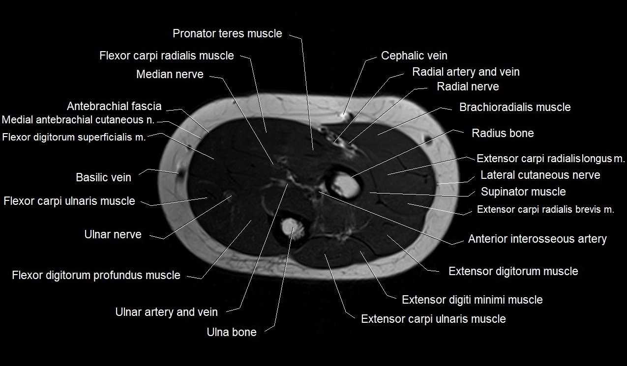 MRI 3T forearm axial cross sectional anatomy image 16.webp